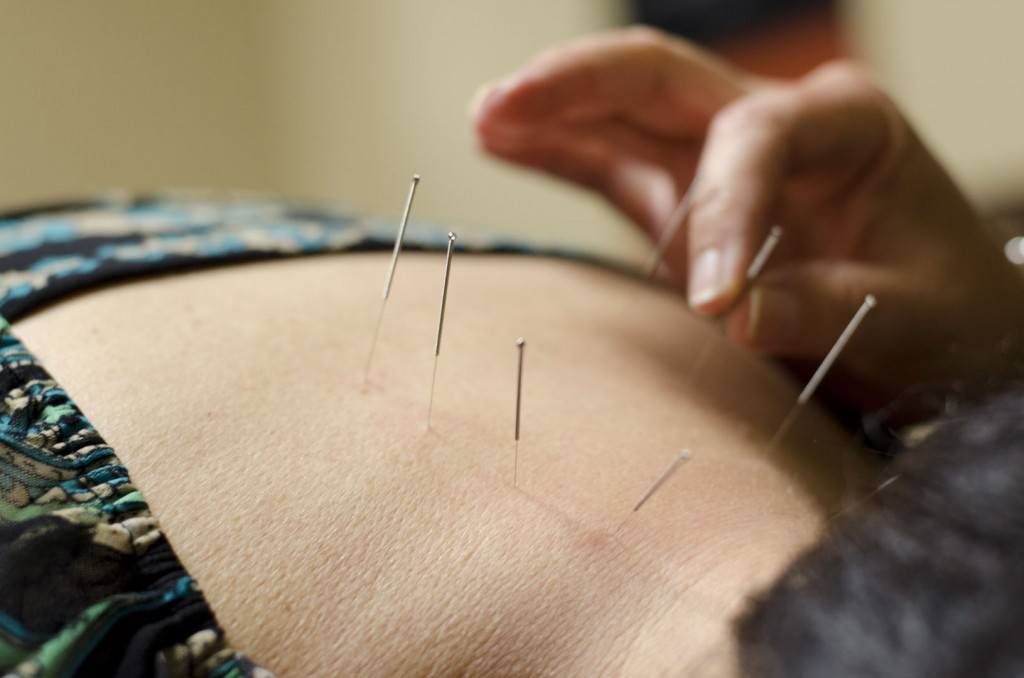 Acupuncture services available with BodyWorkz in Mesa, AZ
