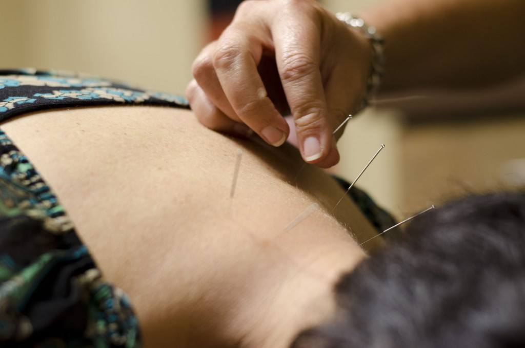 Acupuncture treatment administered by local Mesa chiropractor, Janeen Wallace