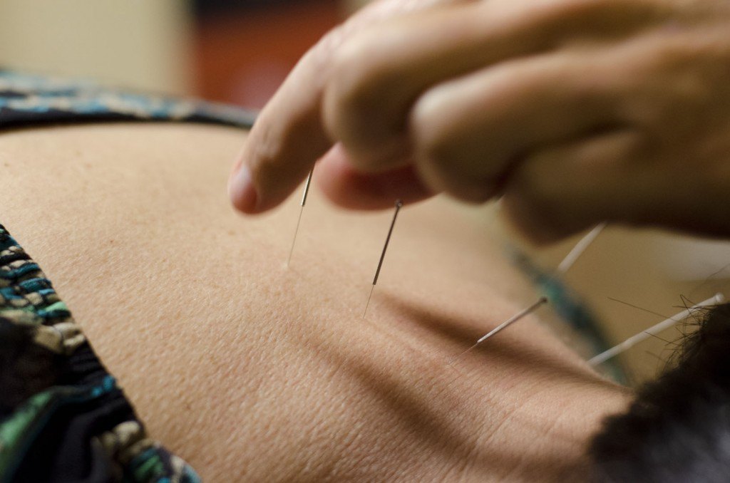 Acupuncture work performed by East Valley chiropractor, Janeen Wallace, with BodyWorkz