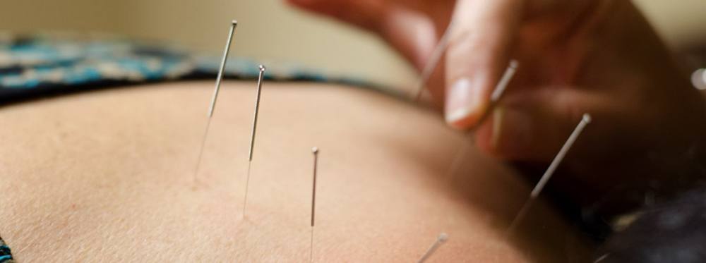 The Top Benefits of Mesa Acupuncture Treatments