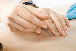 Gilbert Acupuncture Treatments at BodyWorkz
