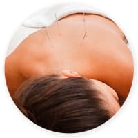 Acupuncture Treatments in Mesa